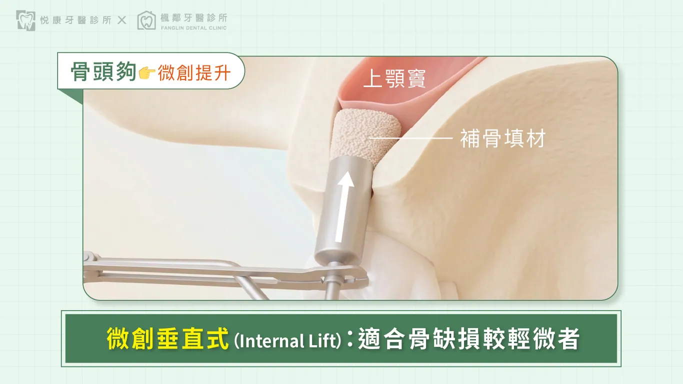台南全口重建推薦盧佳豪醫師